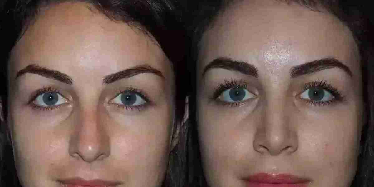 What Should You Avoid During Recovery From Septoplasty in Dubai?
