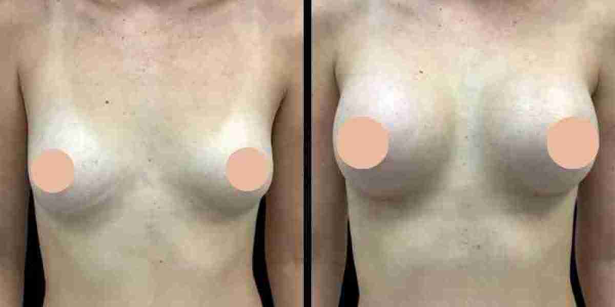 Breast Augmentation in Dubai: What to Expect at Follow-Up Appointments