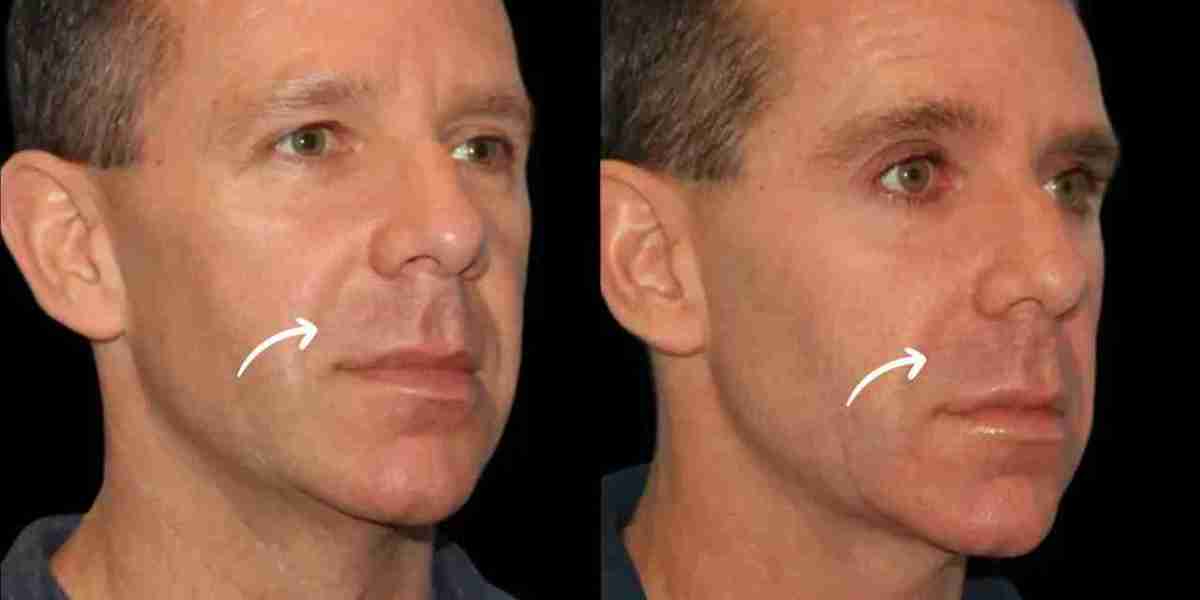 Sculptra in Dubai for Exploring Changing Attitudes Toward Facial Ageing