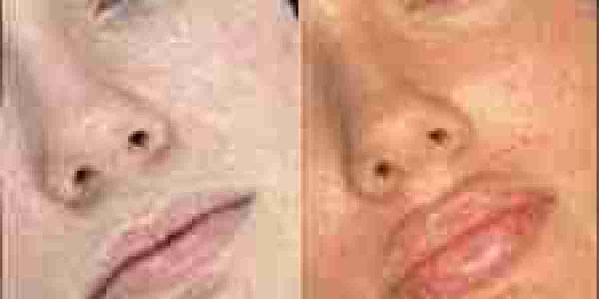 Fillers Treatment in Dubai Patient Safety and Treatment Guide