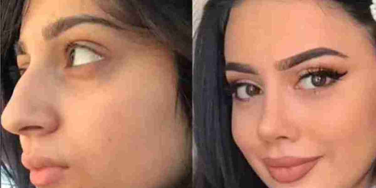 What Recovery Milestones Follow Rhinoplasty in Dubai?